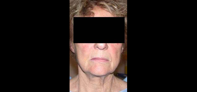 chirurgie-esthetique-interventions-visage-liftings