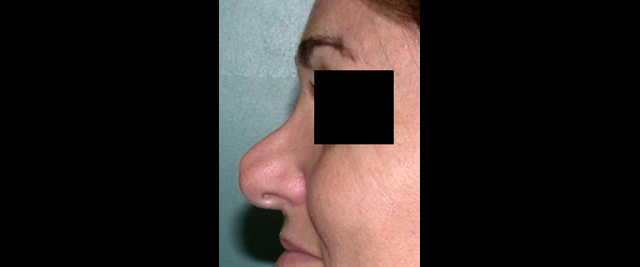 chirurgie-esthetique-chirurgie-secondaire-nez-rhinoplastie-secondaire