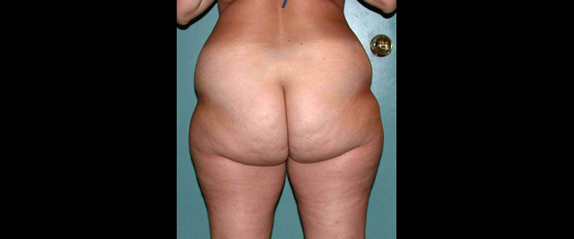 chirurgie-esthetique-interventions-lipoaspirations-liposuccions