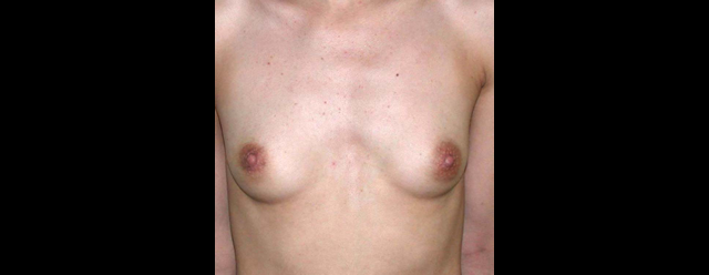 chirurgie-esthetique-interventions-seins-augmentations-mammaires