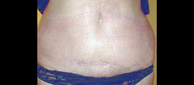 chirurgie-esthetique-interventions-abdomens-abdominoplasties