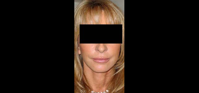 chirurgie-esthetique-interventions-visage-liftings