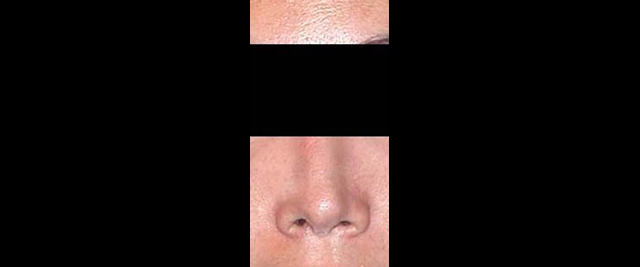 chirurgie-esthetique-chirurgie-secondaire-nez-rhinoplastie-secondaire
