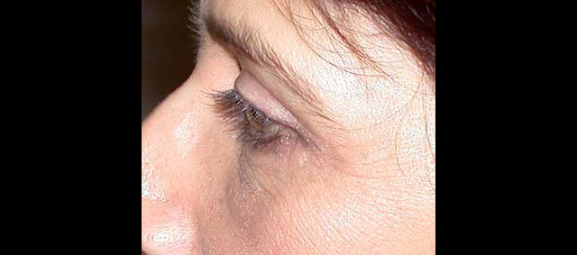 chirurgie-esthetique-interventions-paupieres-blépharoplasties