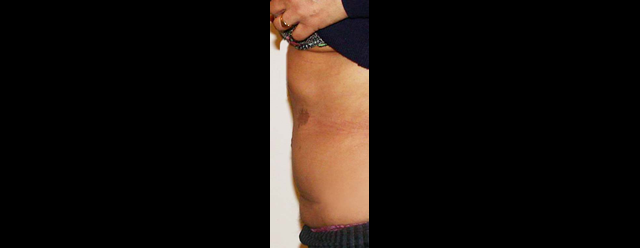 chirurgie-esthetique-interventions-abdomens-abdominoplasties