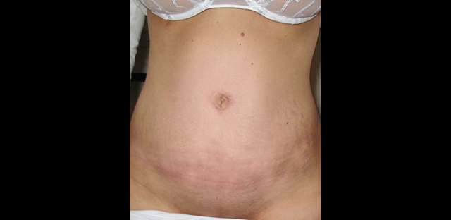 chirurgie-esthetique-interventions-abdomens-abdominoplasties