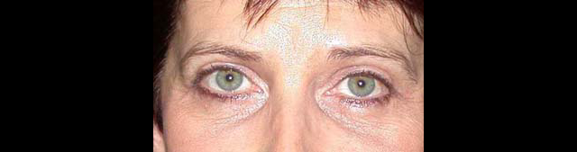 chirurgie-esthetique-interventions-paupieres-blépharoplasties