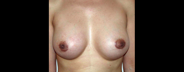 chirurgie-esthetique-interventions-seins-augmentations-mammaires