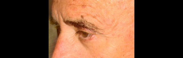 chirurgie-esthetique-interventions-paupieres-blépharoplasties