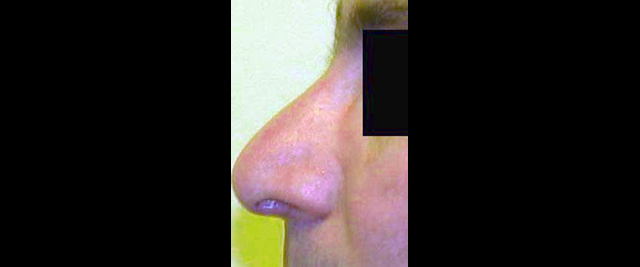 chirurgie-esthetique-chirurgie-secondaire-nez-rhinoplastie-secondaire