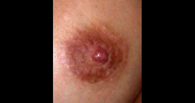 chirurgie-esthetique-interventions-seins-reduction-mamelon-01