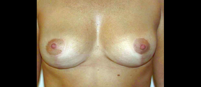 chirurgie-esthetique-interventions-seins-ptoses-mammaires-sans-implant