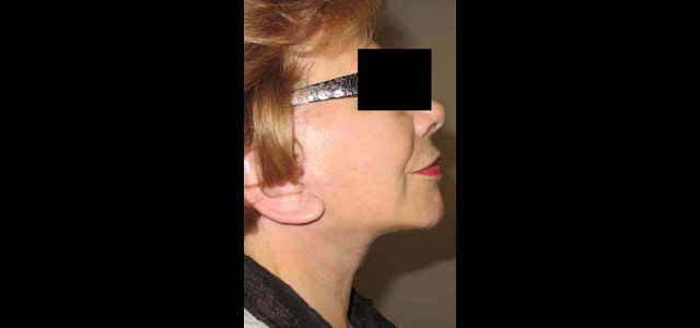 chirurgie-esthetique-interventions-visage-liftings