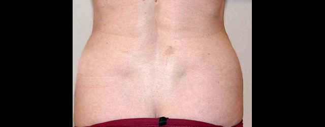 chirurgie-esthetique-interventions-lipoaspirations-liposuccions
