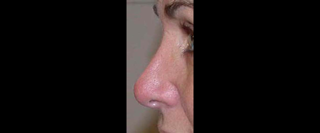 chirurgie-esthetique-chirurgie-secondaire-nez-rhinoplastie-secondaire