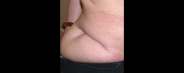 chirurgie-esthetique-interventions-cicatrices-grains-beauté-kystes-tatouages