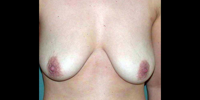 chirurgie-esthetique-interventions-seins-correction-ptose-avec-implants