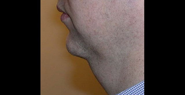 menton en recul et graisse cervicale