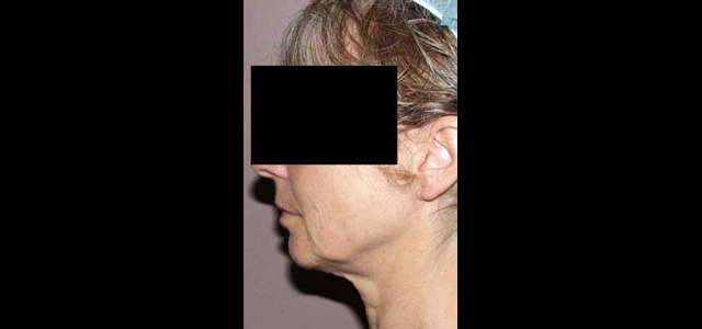 chirurgie-esthetique-interventions-visage-liftings