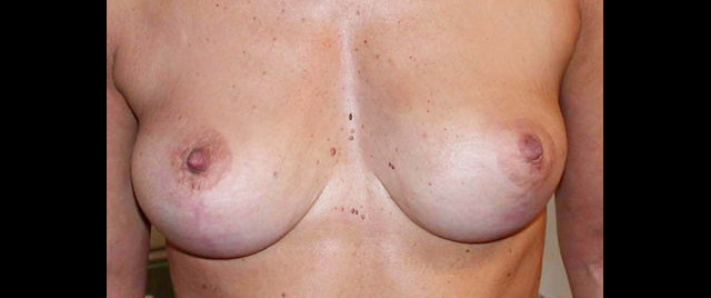 chirurgie-esthetique-interventions-seins-ptoses-mammaires-sans-implant