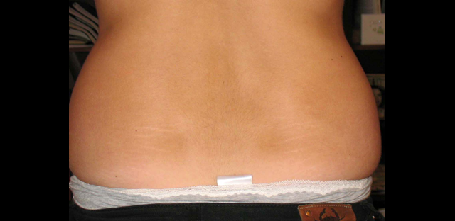 chirurgie-esthetique-interventions-lipoaspirations-liposuccions