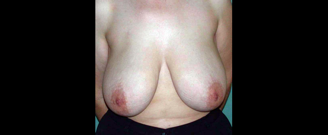chirurgie-esthetique-interventions-seins-reductions-mammaires