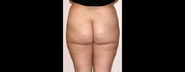 chirurgie-esthetique-interventions-lipoaspirations-liposuccions