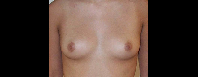 chirurgie-esthetique-interventions-seins-augmentations-mammaires