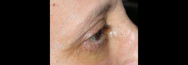 chirurgie-esthetique-interventions-paupieres-blépharoplasties