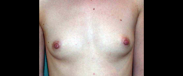 chirurgie-esthetique-interventions-seins-augmentations-mammaires