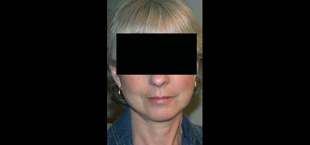 chirurgie-esthetique-interventions-visage-liftings