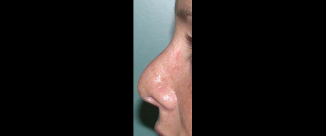 chirurgie-esthetique-chirurgie-secondaire-nez-rhinoplastie-secondaire