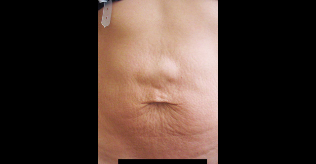 chirurgie-esthetique-interventions-abdomens-abdominoplasties