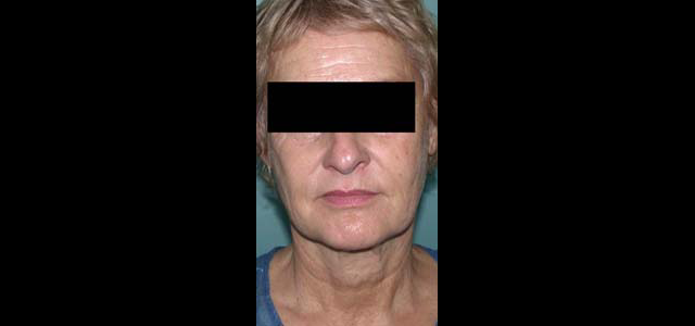 chirurgie-esthetique-interventions-visage-liftings