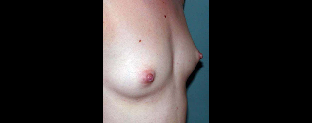 chirurgie-esthetique-interventions-seins-augmentations-mammaires