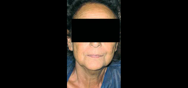 chirurgie-esthetique-interventions-visage-liftings