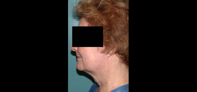 chirurgie-esthetique-interventions-visage-liftings