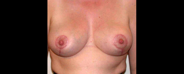 chirurgie-esthetique-interventions-seins-reductions-mammaires