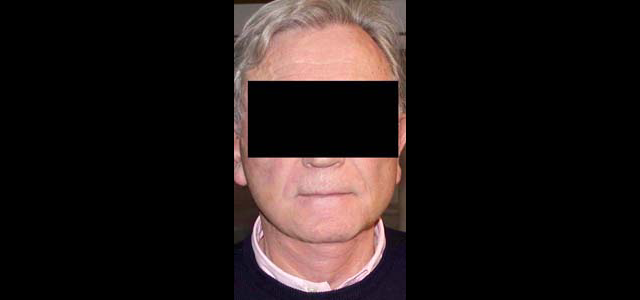 chirurgie-esthetique-interventions-visage-liftings