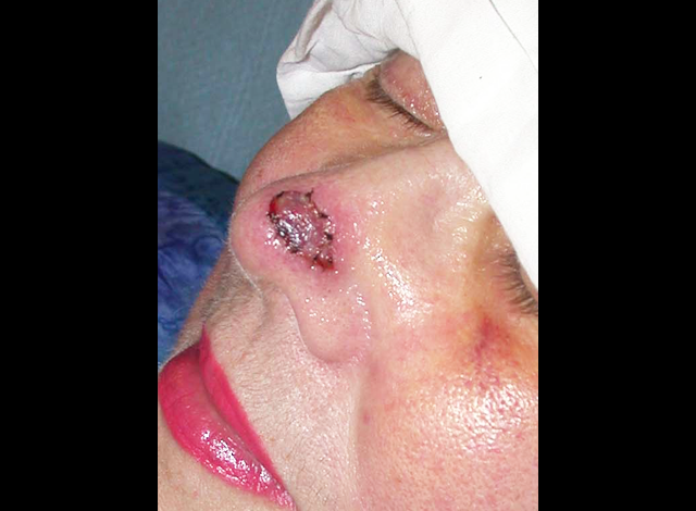 chirurgie-esthetique-cancer-greffe
