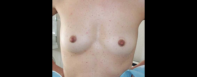 chirurgie-esthetique-interventions-seins-augmentations-mammaires