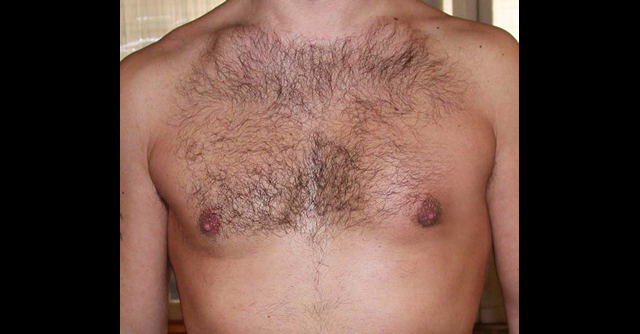 chirurgie-esthetique-interventions-gynecomasties