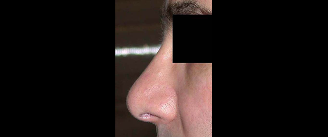 chirurgie-esthetique-chirurgie-secondaire-nez-rhinoplastie-secondaire