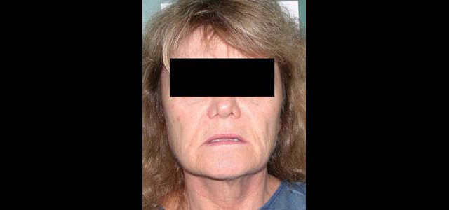 chirurgie-esthetique-interventions-visage-liftings