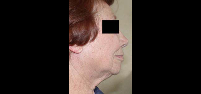 chirurgie-esthetique-interventions-visage-liftings