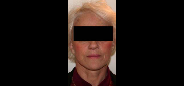 chirurgie-esthetique-interventions-visage-liftings
