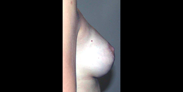 chirurgie-esthetique-interventions-seins-correction-ptose-avec-implants