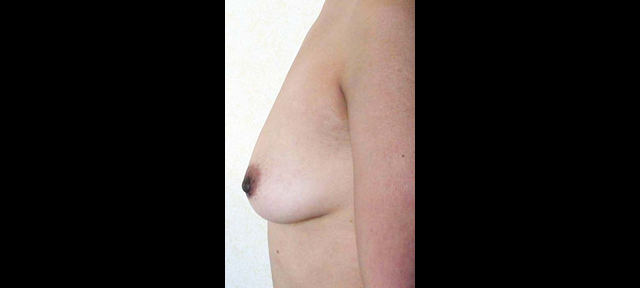 chirurgie-esthetique-interventions-seins-augmentations-mammaires