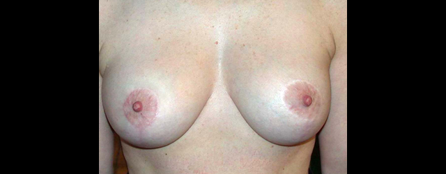 chirurgie-esthetique-interventions-seins-ptoses-mammaires-sans-implant
