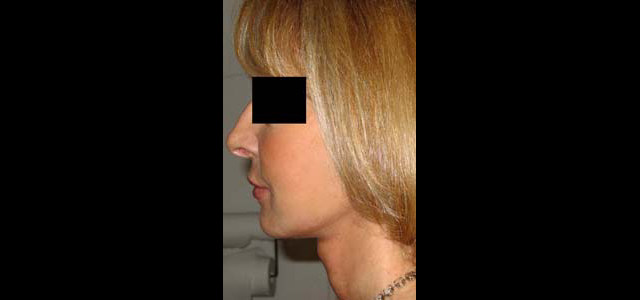 chirurgie-esthetique-interventions-visage-liftings